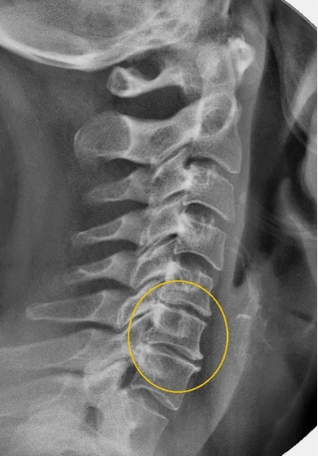 Osteochondroza kręgosłupa szyjnego na x -na